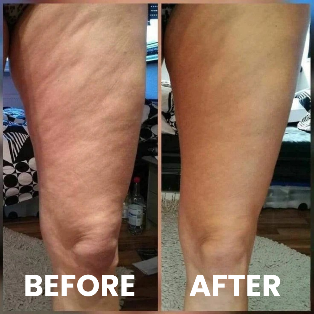 Talnerro™ Anti-Cellulite Massage Roller