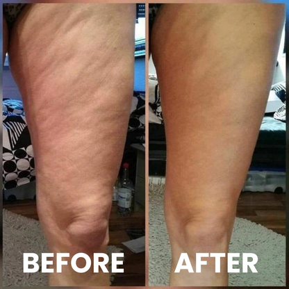 Talnerro™ Anti-Cellulite Massage Roller