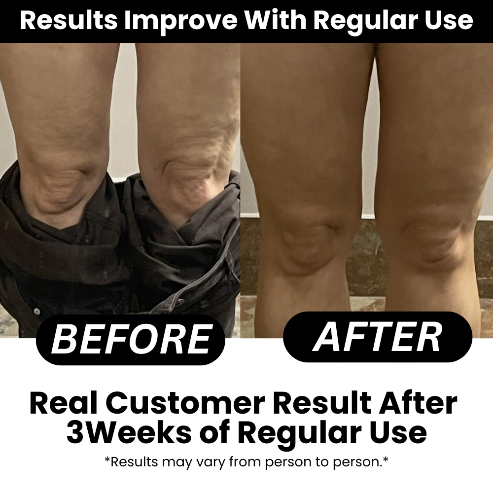 Talnerro™ - Anti-cellulite Massage Oil (240 ml)