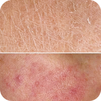Dry, Irritated Skin