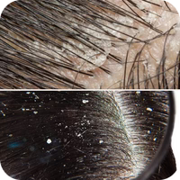 Itchy, Flaky Scalp